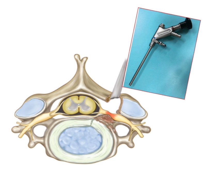 图3 微创脊柱内镜下颈椎后路神经根减压术示意图