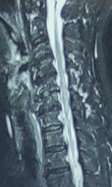 图2 一位80岁老太太颈椎核磁,无神经症状,但每一节都有增生突出表现。