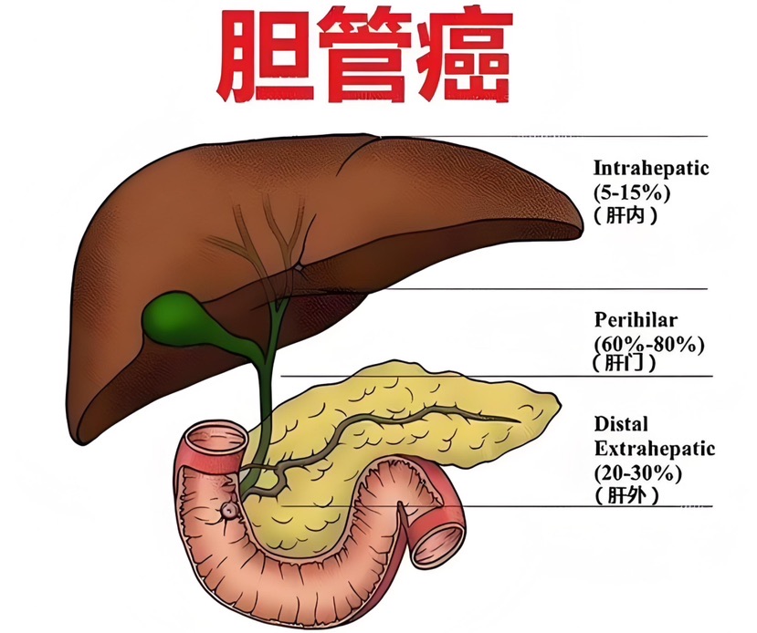 夏令科普｜不要生食水产物！这些胆管癌的高危身分需存眷