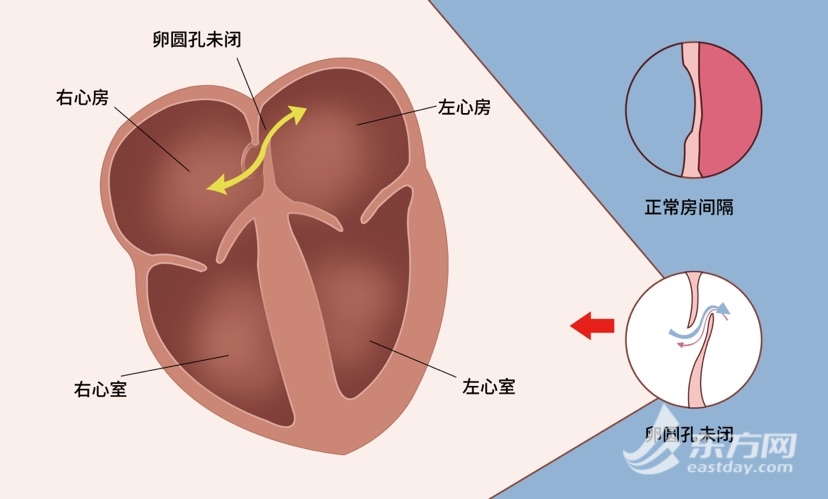 年青患者持久受偏头痛困扰 市七病院“一招”解忧