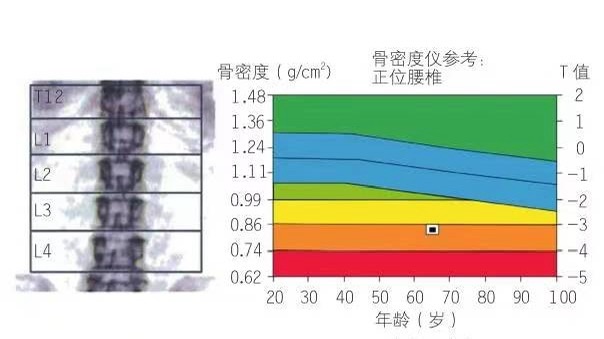 很重要哦。比如，骨密度您做了吗，是不是也如下图图1所示，骨量告急呢！