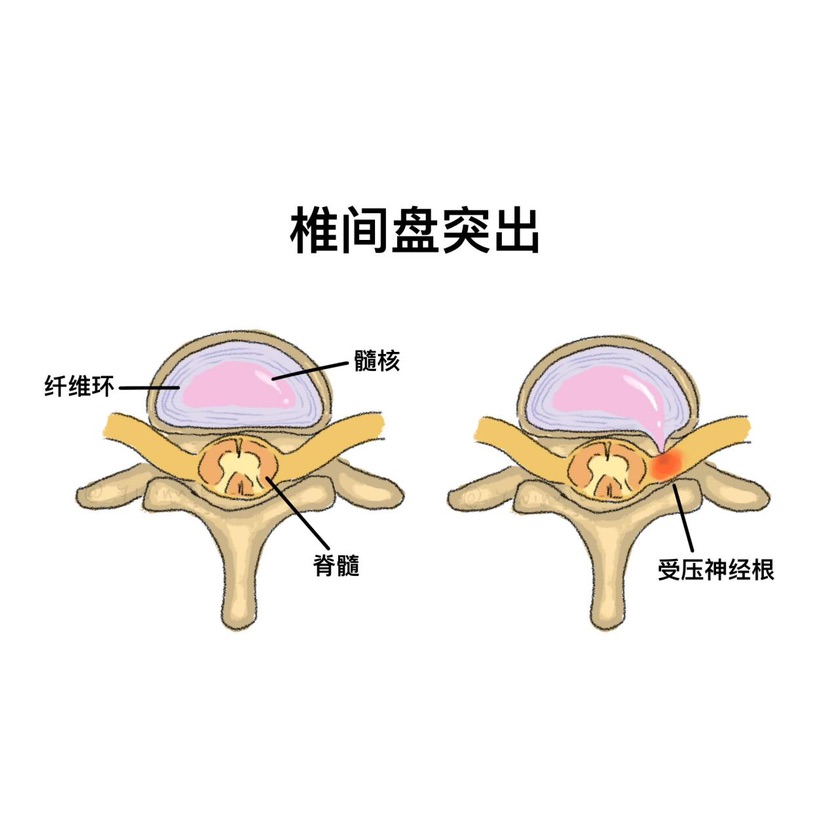 科普｜白领的“隐形敌人”：腰椎间盘凸起