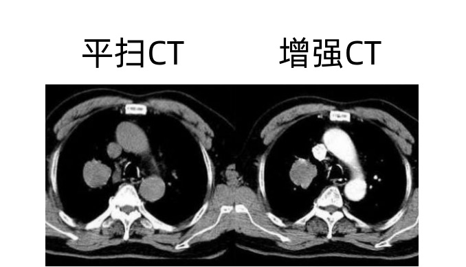 科普｜CT、MR查抄打针药物是甚么？