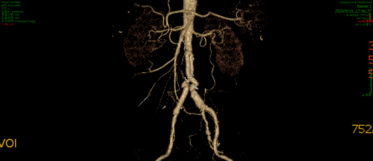 高烧之后“挺一挺”?感染性腹主动脉瘤,随时可能破裂!拆弹+重建,巧手复原腹主动脉