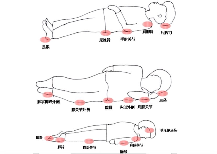 科普｜压疮照护，你不知道的的十二个误区