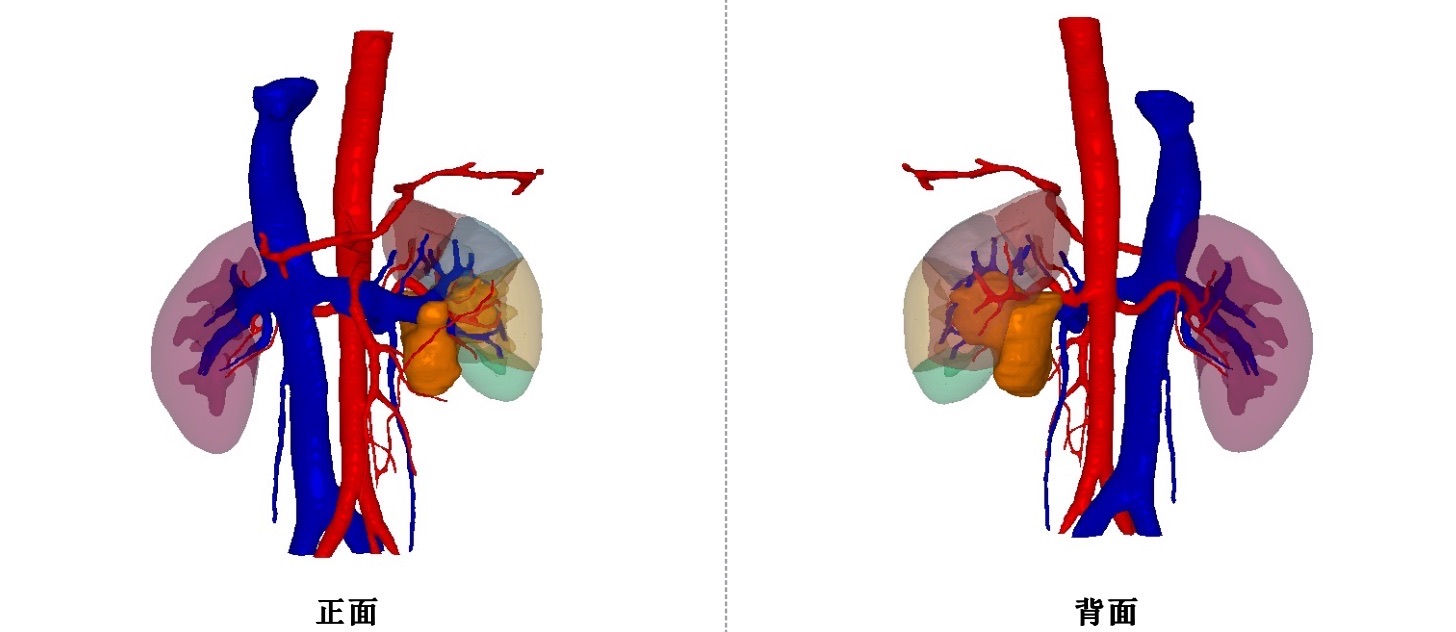 三维重建图像,橙色区域为肿瘤,绿色为肾盂,红色为动脉,蓝色为静脉;可见肿瘤被肾血管包绕