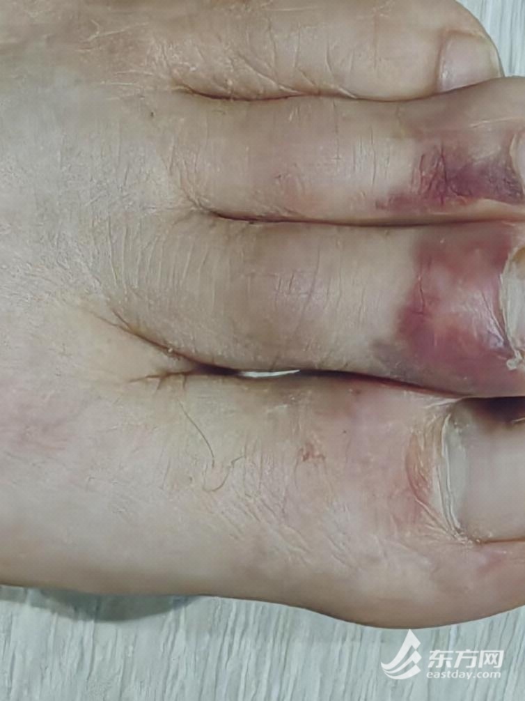 图说:陈壮受伤的脚趾。图源:受访者