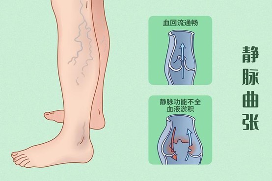 科普|蚯蚓腿,红血丝背后的秘密